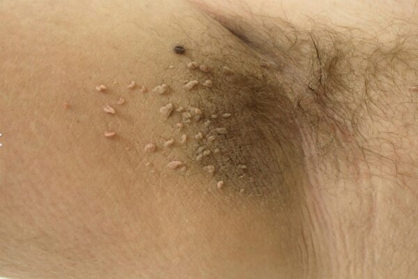 Do You Have Warts We Have The Remedy You Need To Eliminate Them In 5 Days