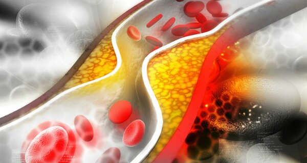 Revealed Cure to Lower Triglycerides, Cholesterol and Blood Sugar 100percent Effective and Natural