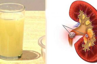 kidney stones