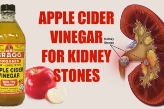Kidney Stones