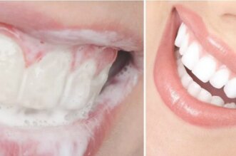 Gingivitis