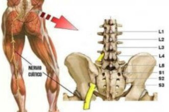 sciatica