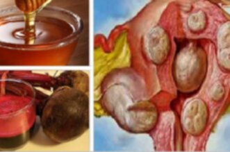 Myomas